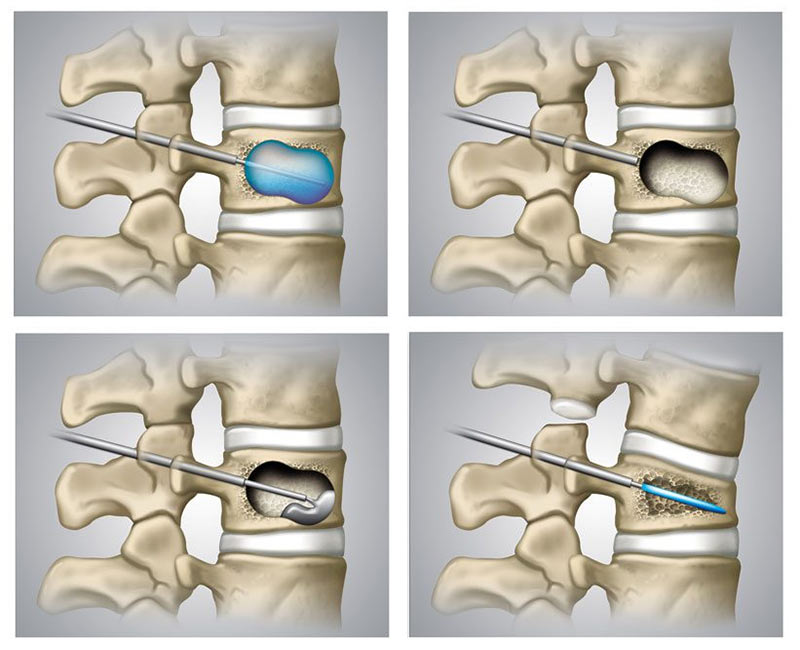 Guiding Your Patient Through Vertebral Compression Fracture