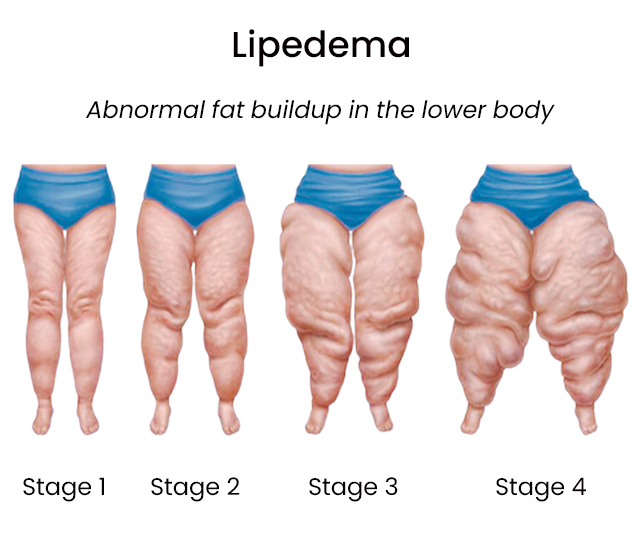 compression garments - Lipedema Surgery Center