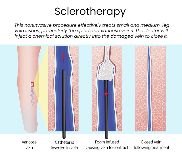 Sclerotherapy