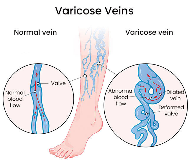 What Causes Hemosiderin Staining