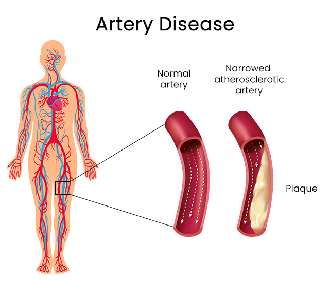 Artery Disease
