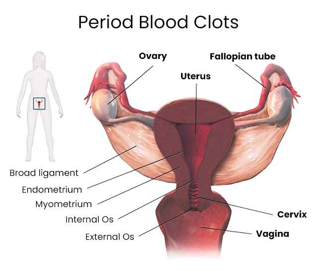 Endometriosis period blood: Color, clots, appearance, and more