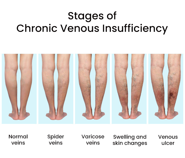 https://www.downtownveinvascular.com/wp-content/uploads/2023/09/Stages-of-Chronic-Venous-Insufficiency.jpg