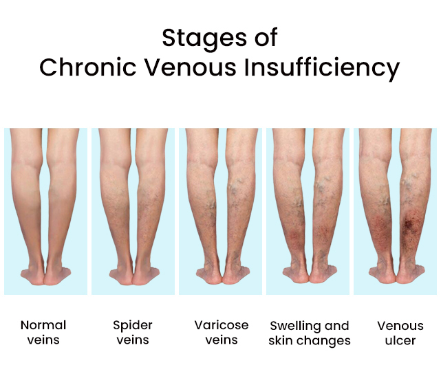 Venous Insufficiency Treatments in Brooklyn, New York - Vascular Specialist