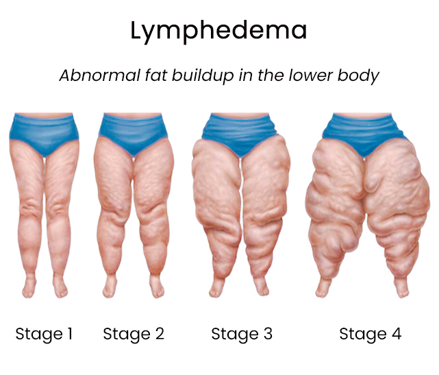 Learn Why Compression Garments Are Great for Lipedema Patients