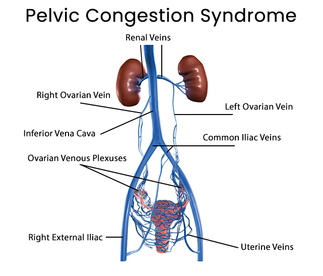 Pelvic Congestion Syndrome Treatments (PCS) in Brooklyn, New York -  Vascular Specialist