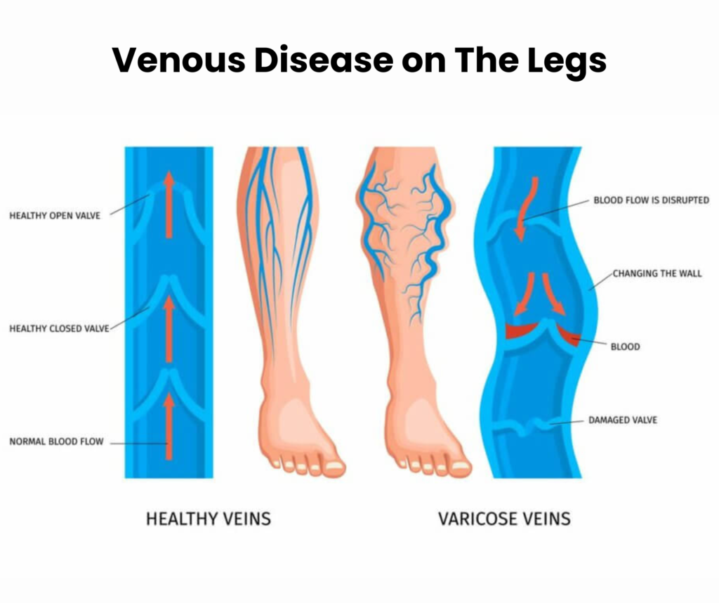 Why Are My Veins Blue And Green? Downtown Vein & Vascular