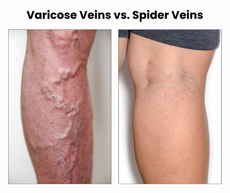 Should I Be Concerned About Dark Veins? - Downtown Vein & Vascular