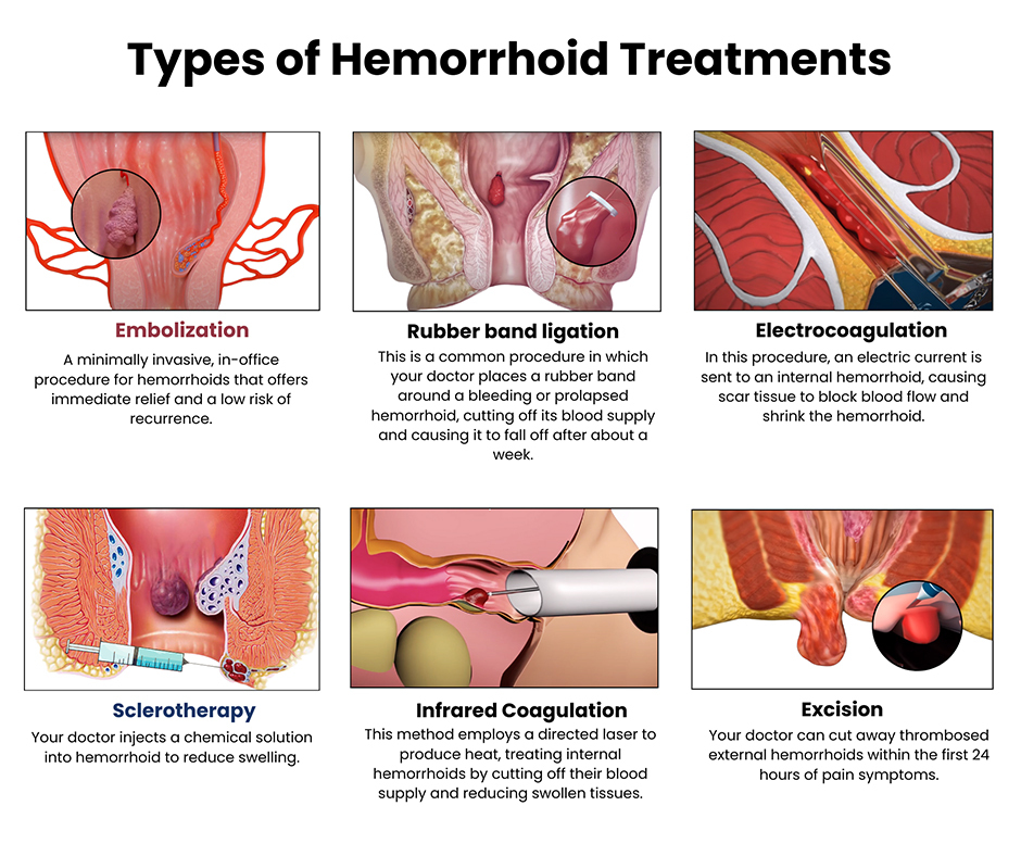 Treatment for external and internal Bleeding hemorrhoids