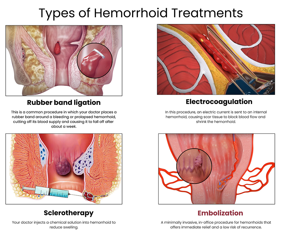 Image result for Beat Hemorrhoids: Top Treatments infographics