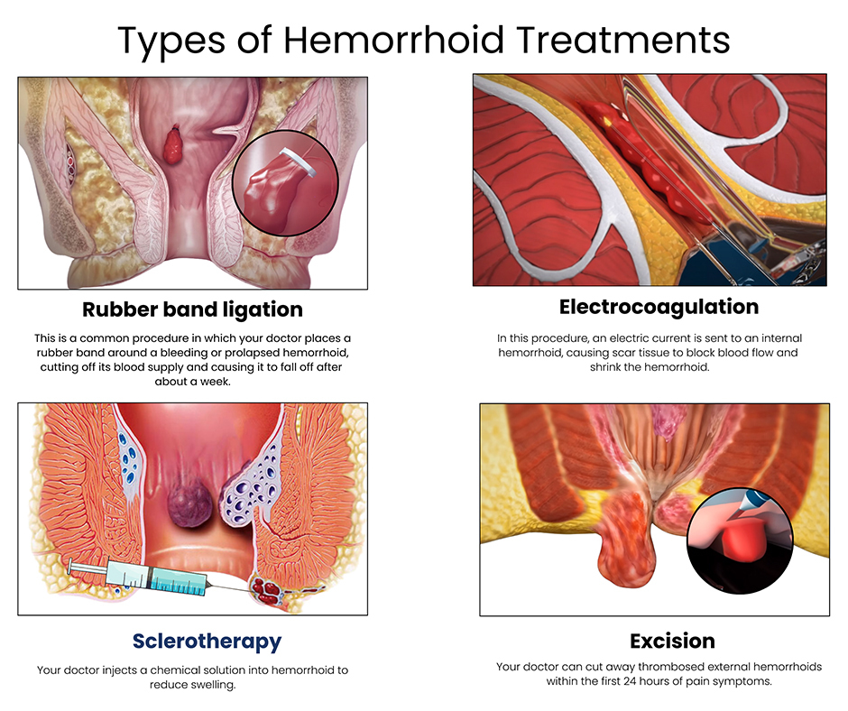 types of hemorrhoid treatments