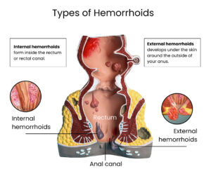 types of hemorrhoids