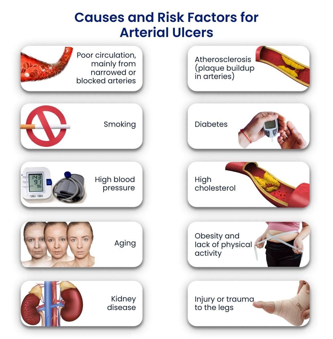Causes and Risk Factors for Arterial Ulcers