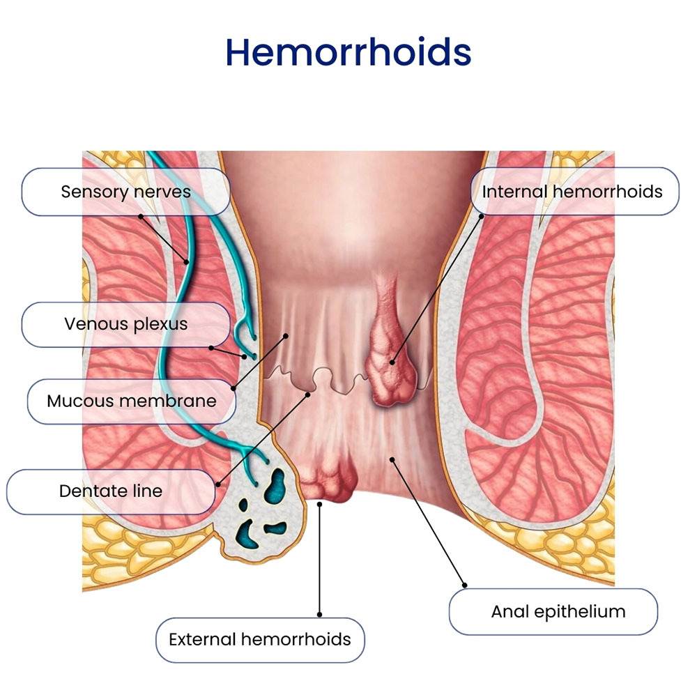 What Do Hemorrhoids Look Like