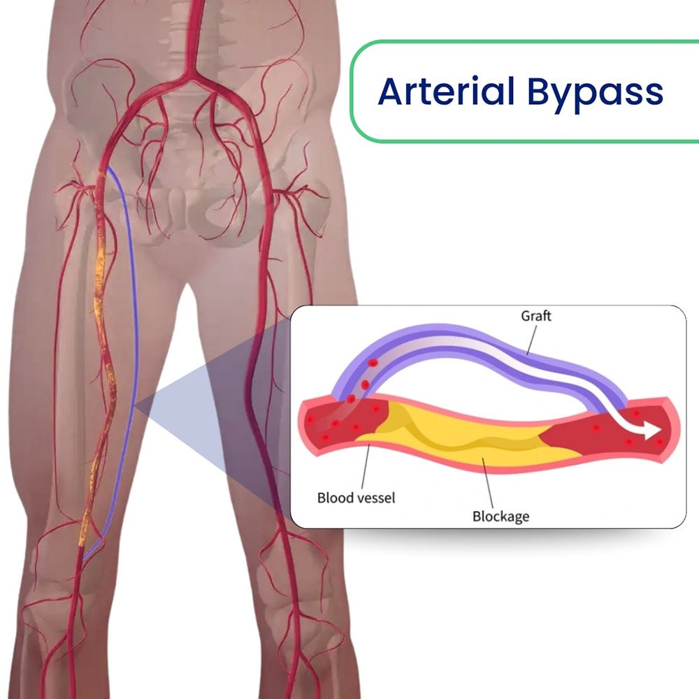 Arterial Bypass
