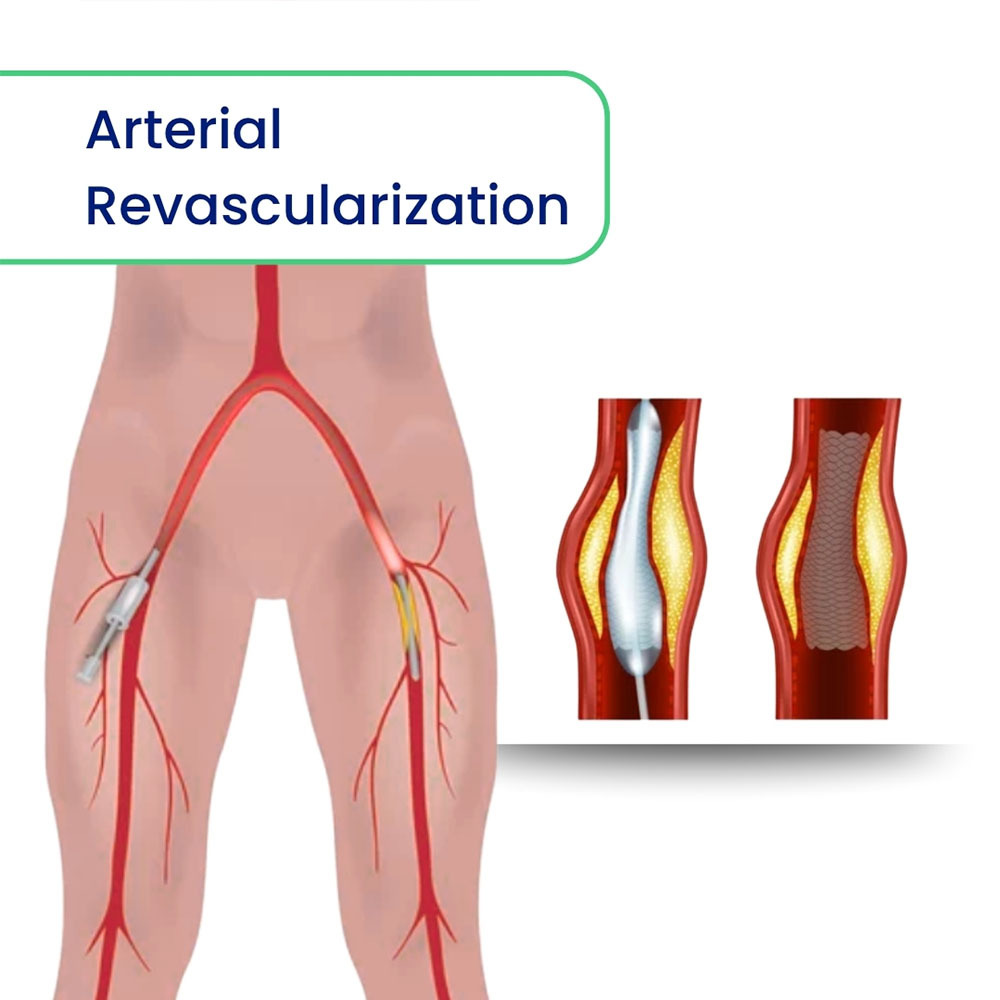 Arterial Revascularization
