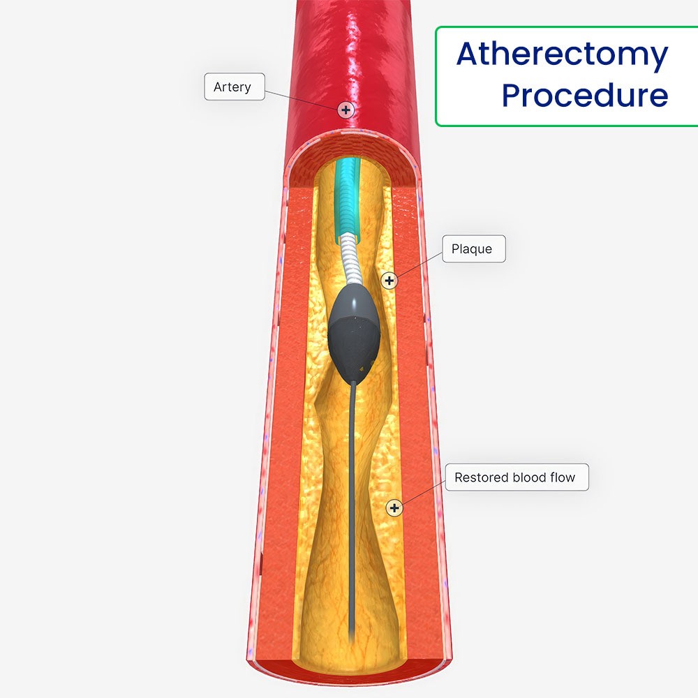 Atherectomy Procedure in Brooklyn NY