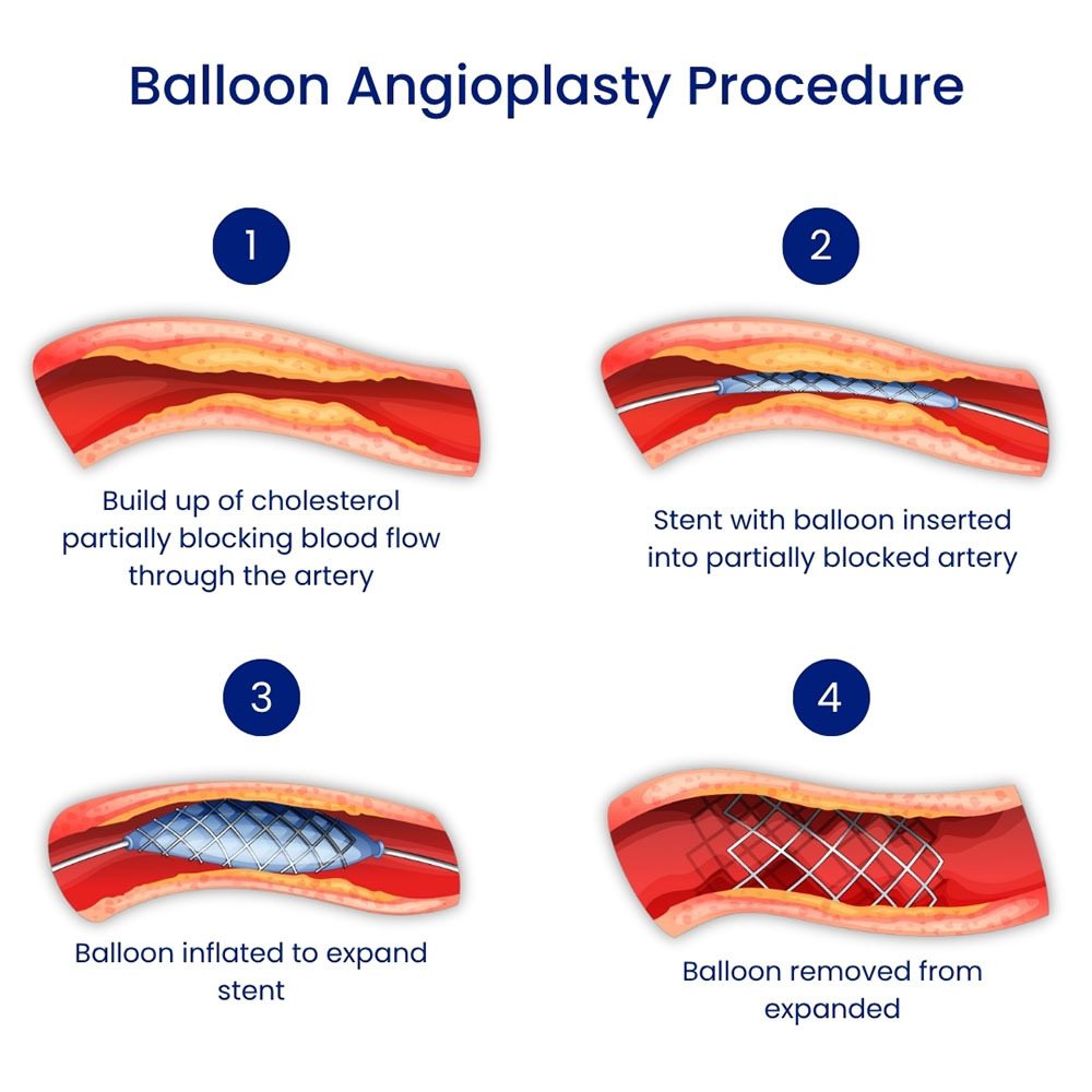 Balloon Angioplasty Procedure in Brooklyn