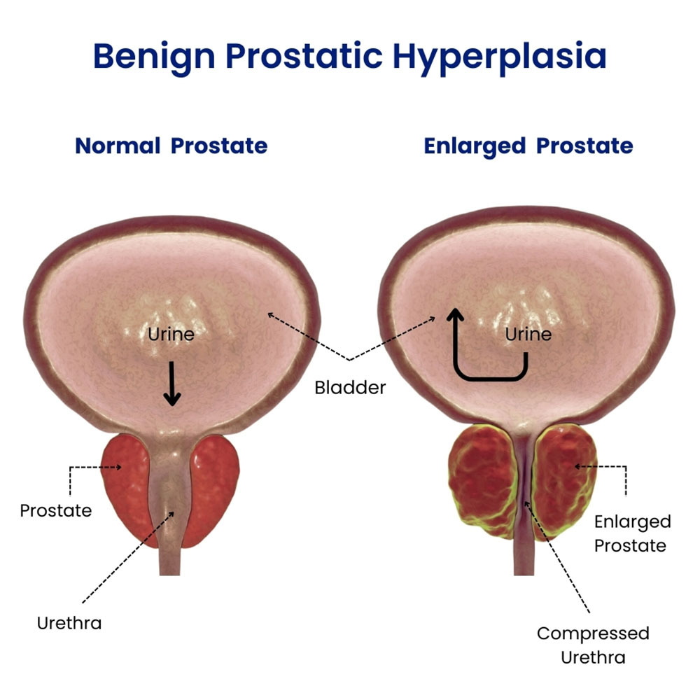 Benign Prostatic Hyperplasia
