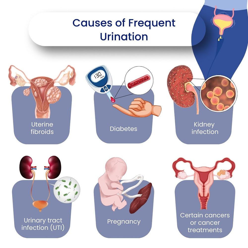 Causes of Frequent Urination