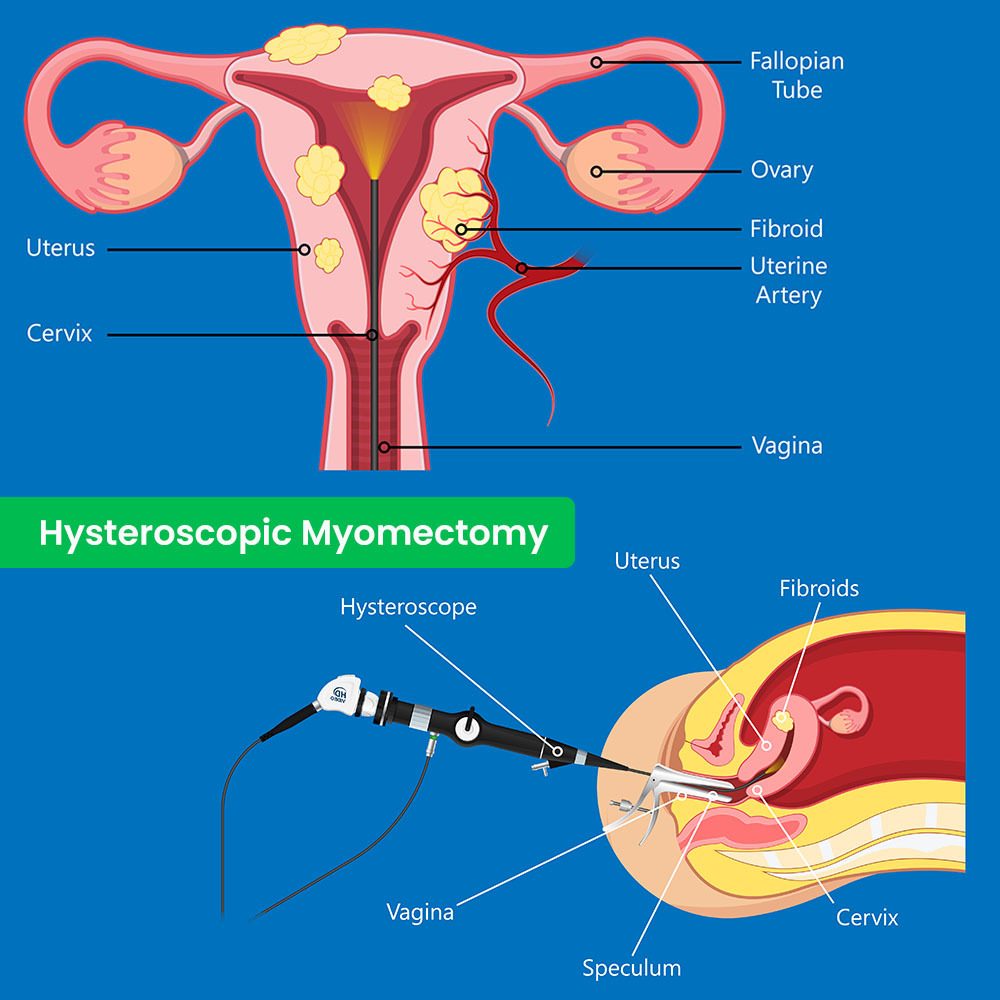 Hysteroscopic Myomectomy in Brooklyn