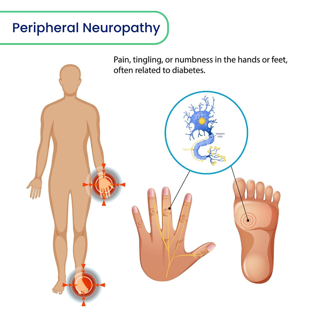 Peripheral Neuropathy