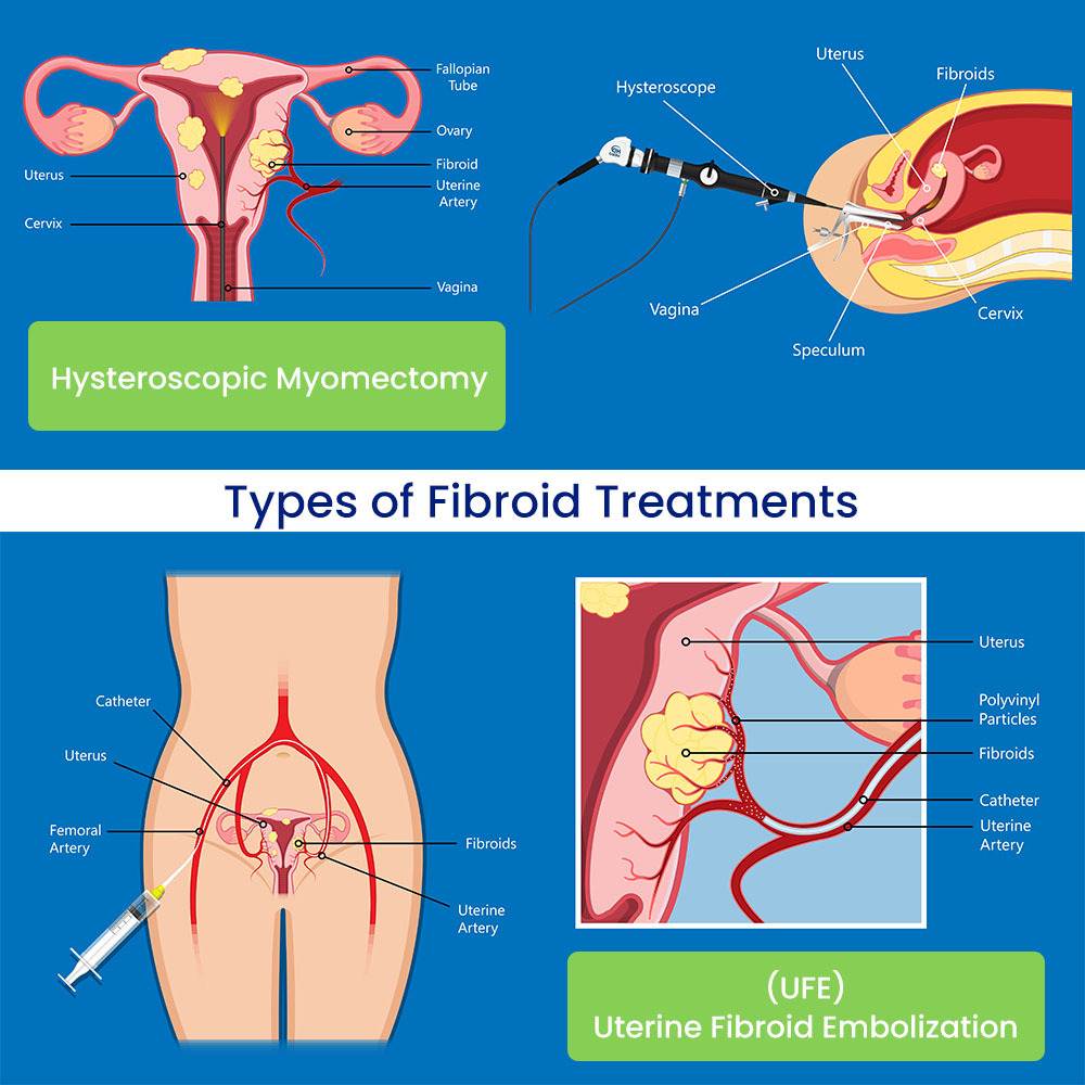 Types of Fibroid Treatments in Brooklyn