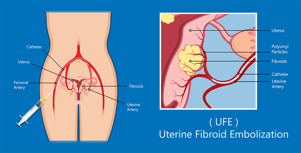 Uterine Fibroid Embolization Anatomy in Brooklyn