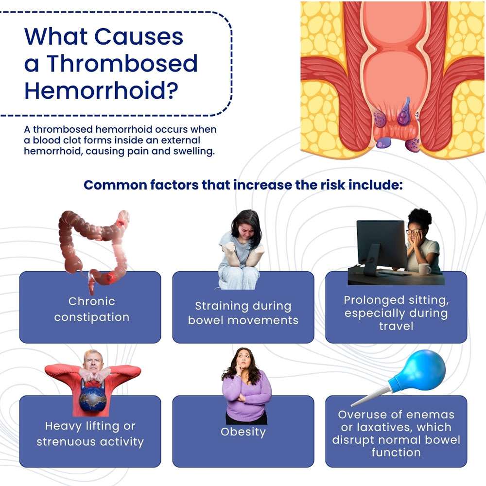 What Causes a Thrombosed Hemorrhoid